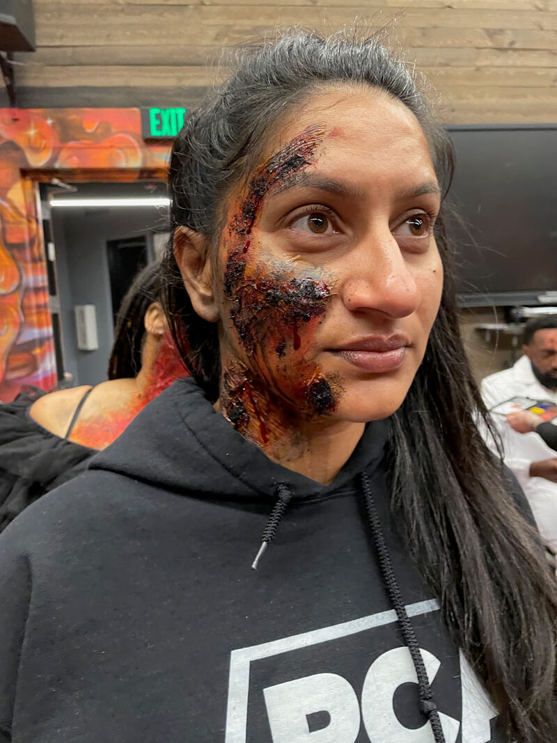 Third Degree Burn Victim